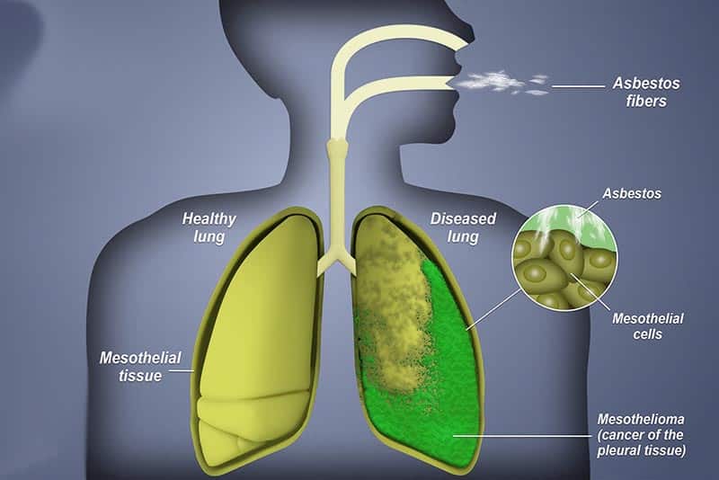 Is Asbestos Compensation Only for Mesothelioma Victims | 800-519-1440