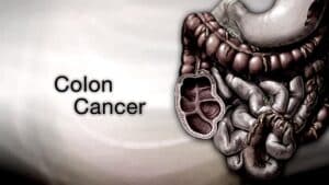 Colorectal Cancer Awareness for Asbestos Victims