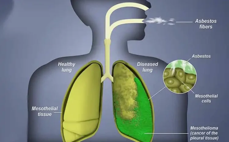  Understanding Asbestos-Related Claims